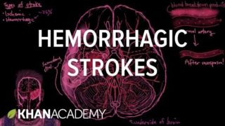 Hemorrhagic strokes | Circulatory System and Disease | NCLEX-RN | Khan Academy