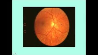 Hypertensive Retinopathy – CRASH! Medical Review Series