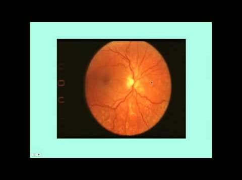Hypertensive Retinopathy – CRASH! Medical Review Series