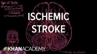 Ischemic stroke | Circulatory System and Disease | NCLEX-RN | Khan Academy