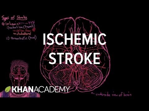 Ischemic stroke | Circulatory System and Disease | NCLEX-RN | Khan Academy
