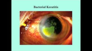 Keratitis – CRASH! Medical Review Series