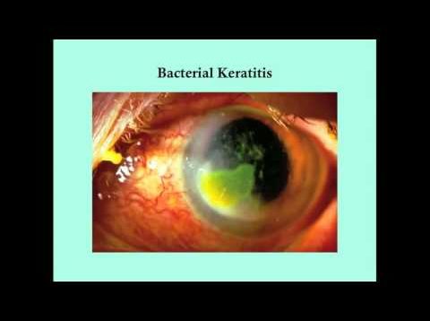 Keratitis – CRASH! Medical Review Series