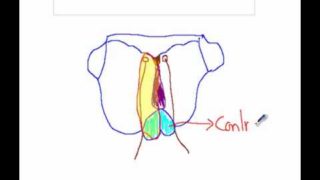 Medial Medullary Syndrome