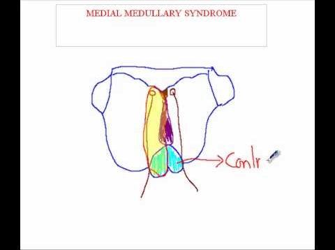 Medial Medullary Syndrome