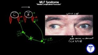 MLF syndrome – Internuclear Ophthalmoplegia, MADE EASY