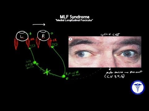 MLF syndrome – Internuclear Ophthalmoplegia, MADE EASY