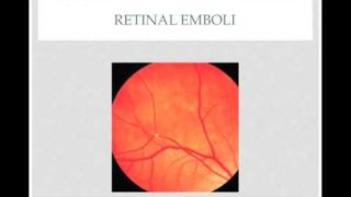 Ophthalmic Emergency: Central Retinal Artery Occlusion – Quick Review