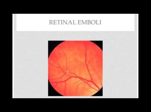 Ophthalmic Emergency: Central Retinal Artery Occlusion – Quick Review