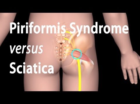 Piriformis Syndrome versus Sciatica, Animation.