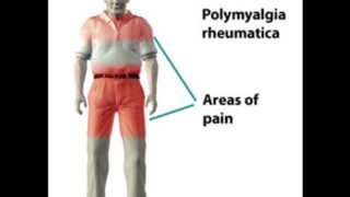 Polymyalgia Rheumatica
