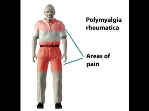 Polymyalgia Rheumatica