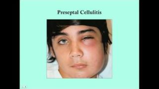 Preseptal and Orbital Cellulitis – CRASH! Medical Review Series