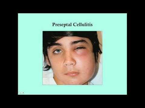 Preseptal and Orbital Cellulitis – CRASH! Medical Review Series