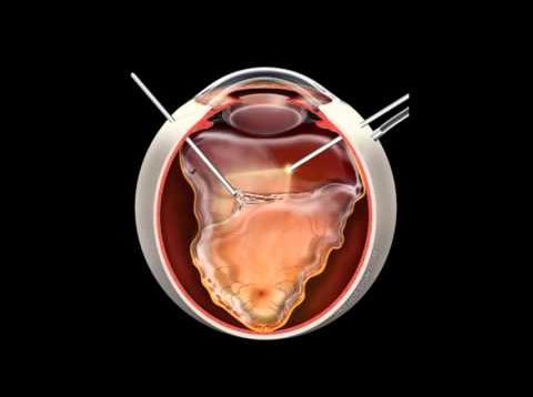 Retinal Detachment | Signs, Symptoms and Treatment