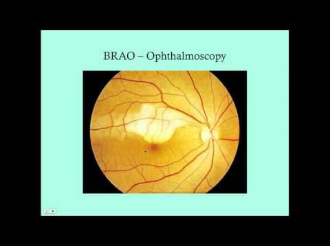 Retinal Vascular Disorders – CRASH! Medical Review Series