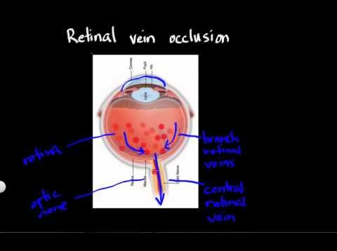 Retinal vein occlusion