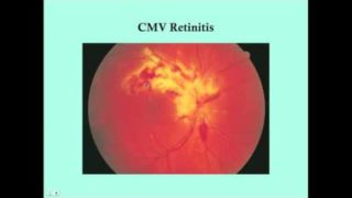 Retinitis – CRASH! Medical Review Series
