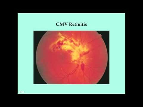 Retinitis – CRASH! Medical Review Series