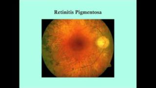 Retinitis Pigmentosa – CRASH! Medical Review Series