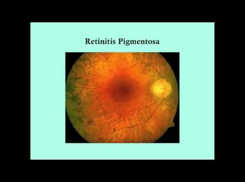 Retinitis Pigmentosa – CRASH! Medical Review Series