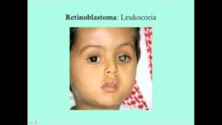 Retinoblastoma – CRASH! Medical Review Series