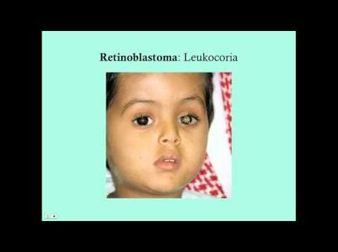 Retinoblastoma – CRASH! Medical Review Series