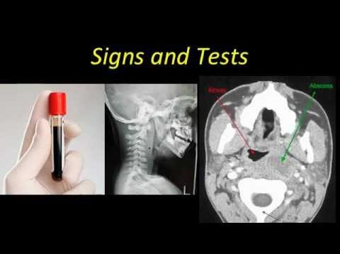 Retropharyngeal Abscess