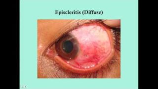 Scleritis – CRASH! Medical Review Series