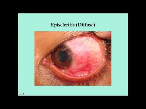 Scleritis – CRASH! Medical Review Series