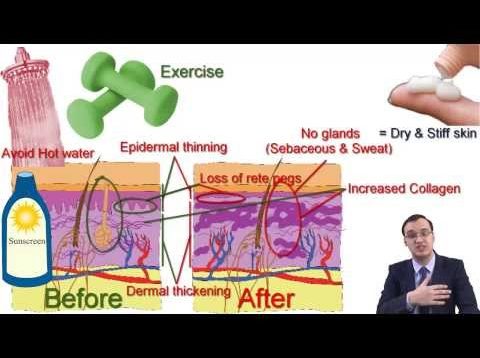 Scleroderma (Systemic sclerosis)