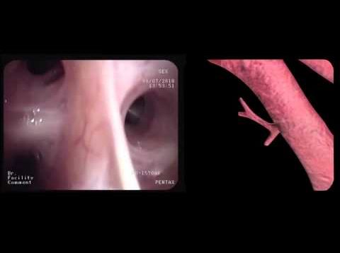 Segmental anatomy (www.bronchoscopy.nl)