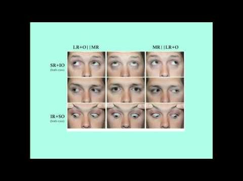 Strabismus – CRASH! Medical Review Series