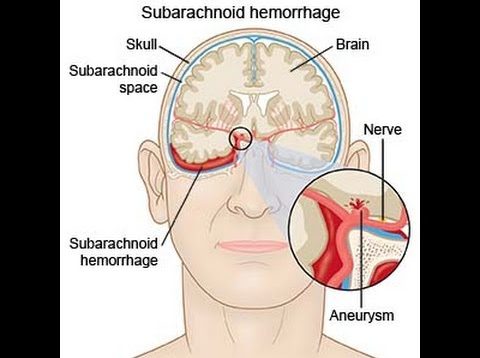 Subarachnoid Hemorrhage