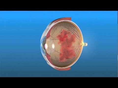 Vitreous Hemorrhage