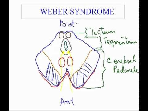 Weber Syndrome