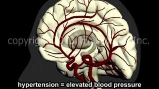 What Is A Stroke? – Narration and Animation by Cal Shipley, M.D.