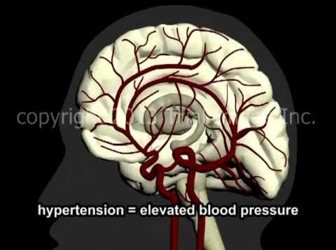 What Is A Stroke? – Narration and Animation by Cal Shipley, M.D.