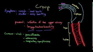 What is croup?