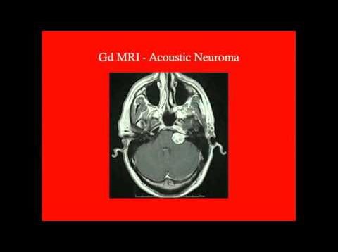 Acoustic Neuroma – CRASH! Medical Review Series