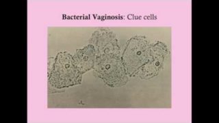 Bacterial Vaginosis in Pregnancy – CRASH! Medical Review Series