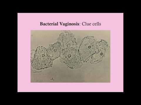 Bacterial Vaginosis in Pregnancy – CRASH! Medical Review Series
