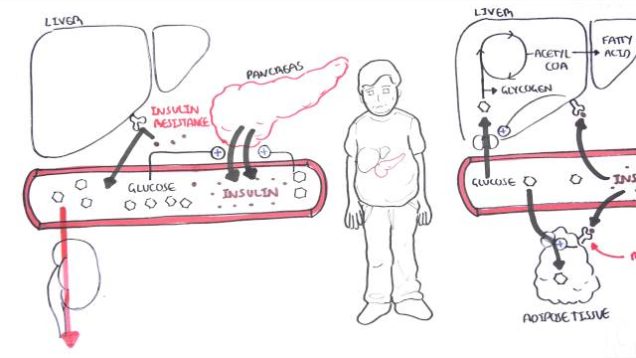 Diabetes Type II Pathophysiology