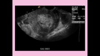 Endometritis – CRASH! Medical Review Series