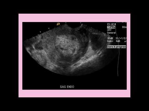 Endometritis – CRASH! Medical Review Series