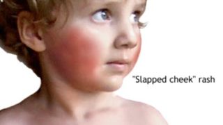 Erythema Infectiosum