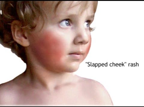 Erythema Infectiosum