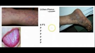 LICHEN PLANUS