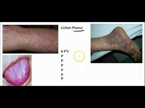 LICHEN PLANUS