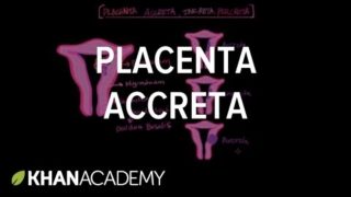 Placenta accreta |  Reproductive system physiology | NCLEX-RN | Khan Academy